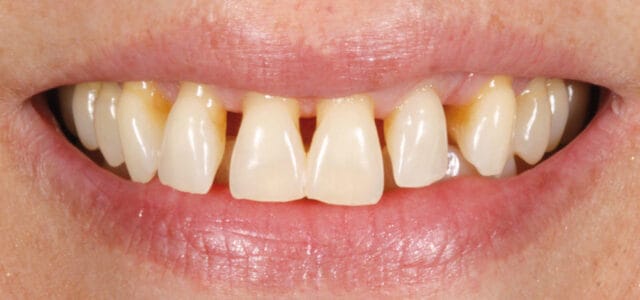 Triángulos negros por periodontitis