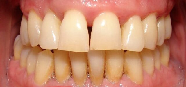 Troneras en los dientes por periodontitis