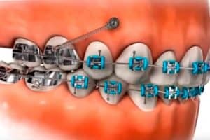 Microimplantes en un tratamiento de ortodoncia