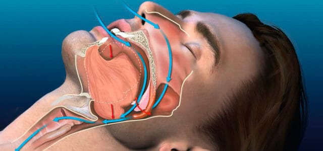 Ronquidos: solución para dejar de roncar - Prodental Santa Cruz