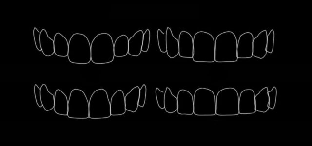 Gráfico que muestra cómo es el diseño de sonrisa
