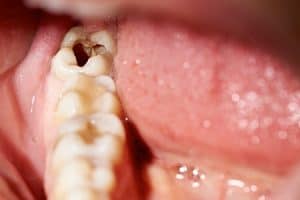 Ante qué síntomas debes acudir al dentista