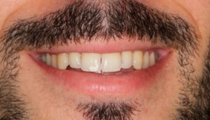Antes