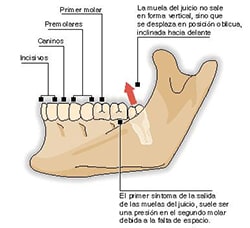 Muelas del juicio cuanto dura la inflamacion